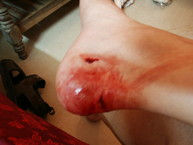 足の傷